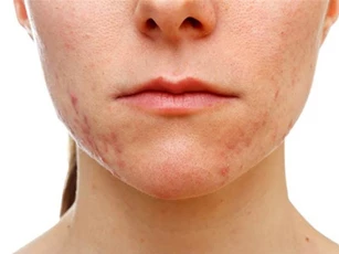 5 bước giúp làn da mềm mịn trở lại sau khi bị dị ứng mỹ phẩm
