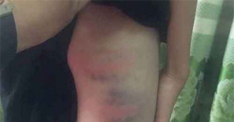 Mẹ kế đánh bé trai nhập viện vì không rót nước mời khách