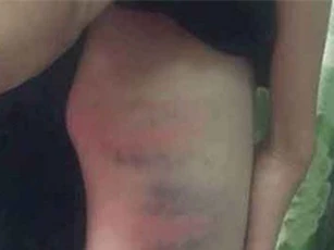 Mẹ kế đánh bé trai nhập viện vì không rót nước mời khách