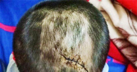 Bé 3 tuổi nghi bị cha dượng bạo hành