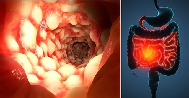 Chế độ ăn uống cho người bị viêm đại tràng