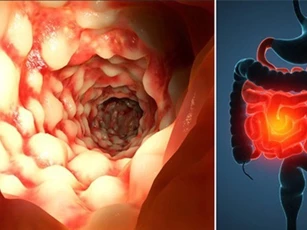 Chế độ ăn uống cho người bị viêm đại tràng