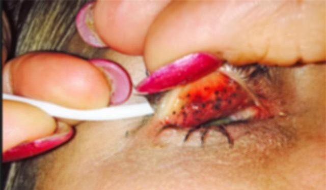 Không tẩy trang mascara đúng cách có thể dẫn đến mù lòa