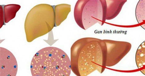 4 nguyên nhân gây gan nhiễm mỡ và cách phòng tránh