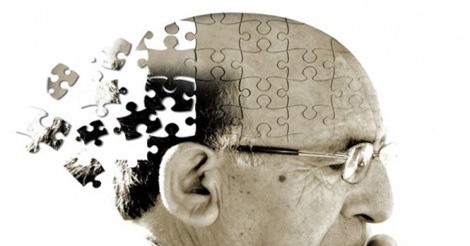 Béo phì có thể liên quan tới khởi phát sớm bệnh Alzheimer