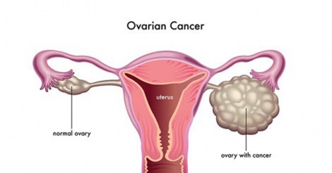 Hơn 240.000 người mắc ung thư buồng trứng mỗi năm