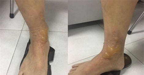 Bỏng nặng do đi mát xa, chỉ dẫn sơ cứu kịp thời