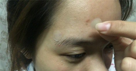 Miếng dán trị mụn không chữa được mụn