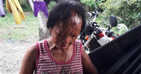 Gia cảnh thương tâm của em bé bị mù do bị tạt axít xin đôi mắt tử tù Nguyễn Hữu Tình