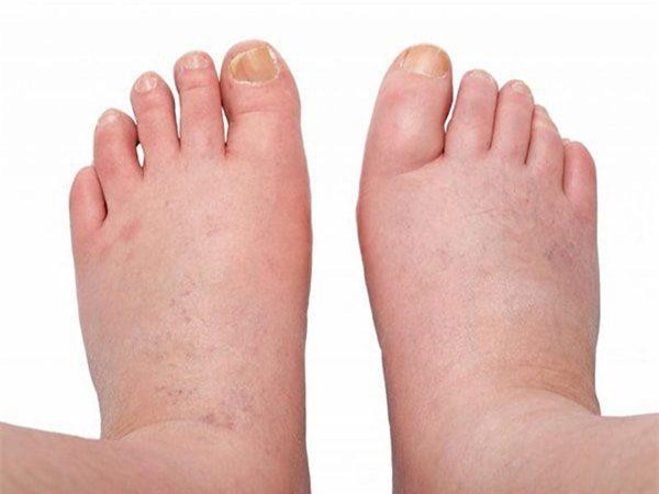 Phù chân – dấu hiệu của nhiều bệnh lý nguy hiểm