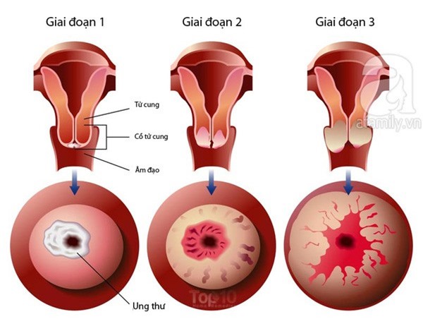 Phát hiện sớm ung thư cổ tử cung bằng xét nghiệm tế bào âm đạo