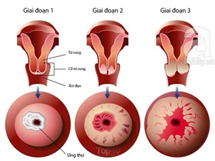 Phát hiện sớm ung thư cổ tử cung bằng xét nghiệm tế bào âm đạo