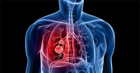 Hai phương pháp mới chữa trị ung thư phổi hiệu quả