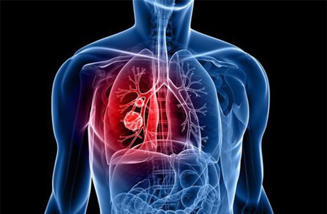 Gia tăng số ca mắc ung thư phổi tại Việt Nam