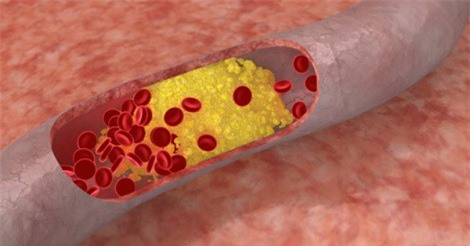 6 tác hại nguy hiểm của bệnh máu nhiễm mỡ