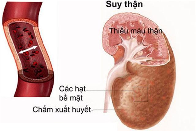 Cách ăn uống tốt cho người suy thận