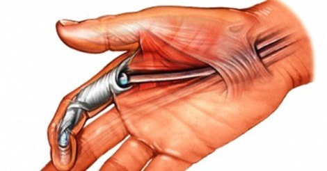 Bệnh ngón tay lò xo, những dấu hiện nhận biết ở trẻ nhỏ