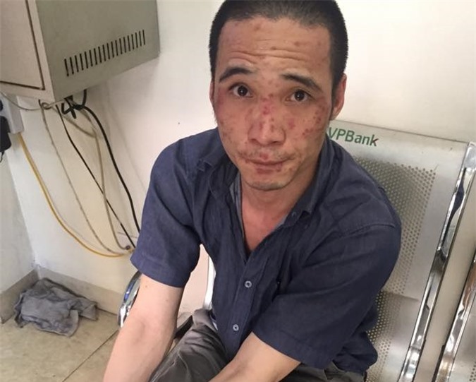 Phát hiện đối tượng sử dụng ma túy đá, dị ứng nổi lên ở mặt