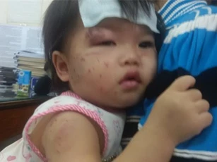 Bé một tuổi bị cào cấu chi chít tại nhà trẻ tư thục ở Gia Lai